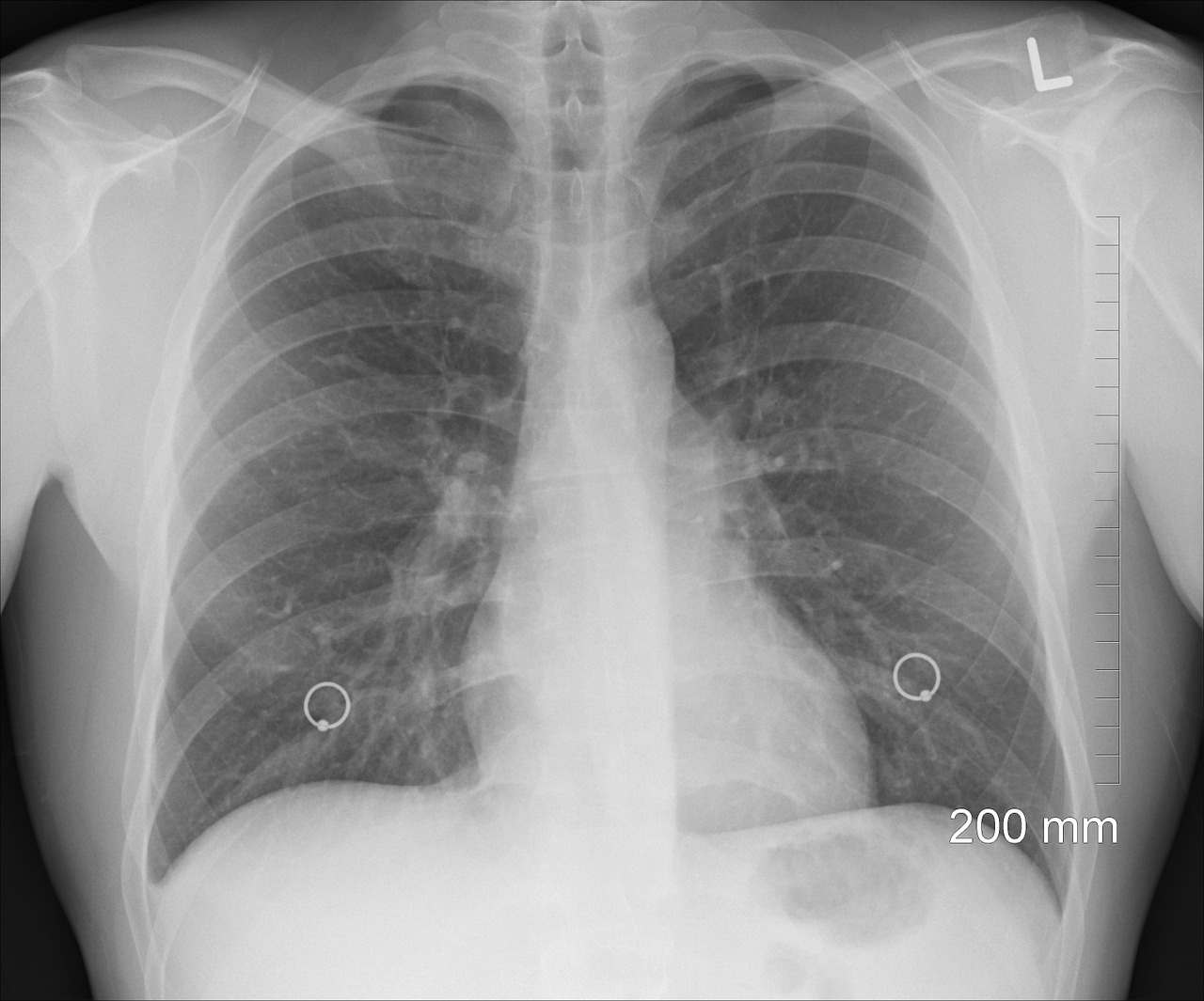 ecografia polmonare